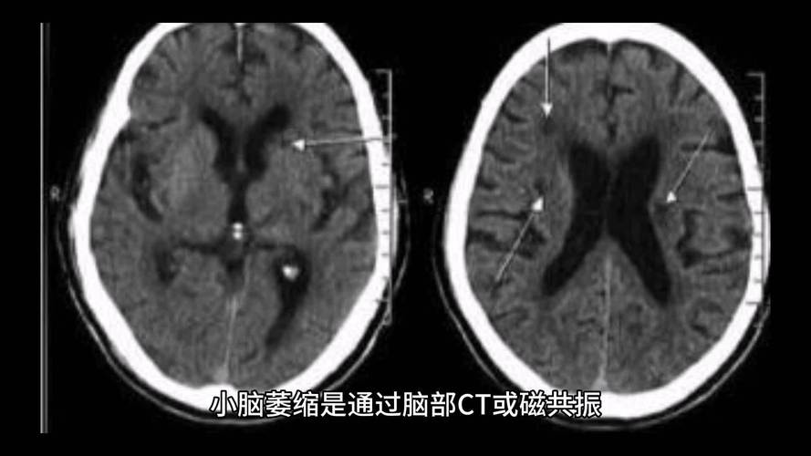去澳门读研究生需要什么条件和送小脑萎缩儿子高考与小脑萎缩能上学吗